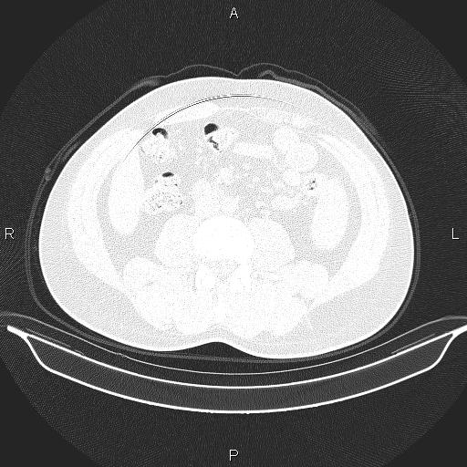 Beam hardening and ring artifacts (Radiopaedia 85323-100915 Axial lung window 96).jpg