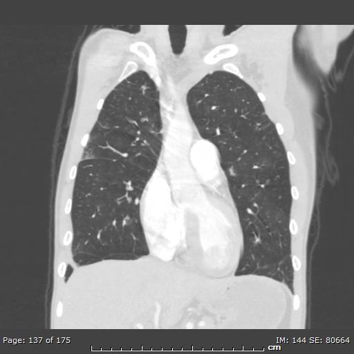 Behçet disease (Radiopaedia 44247-47889 Coronal lung window 43).jpg