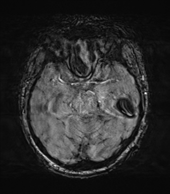 File:Behavioral variant frontotemporal dementia and late onset schizophrenia (Radiopaedia 52197-58083 Axial SWI 26).png