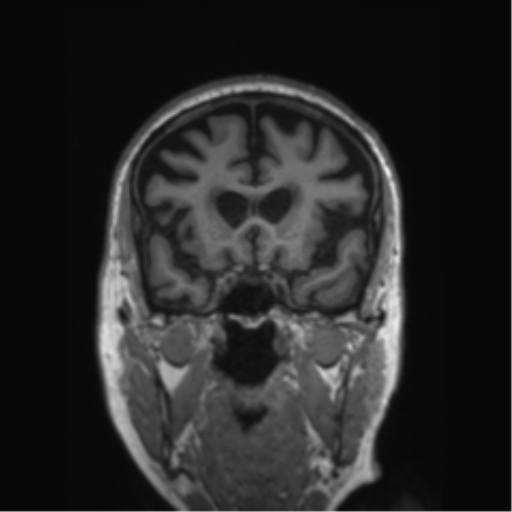 Behavioral variant frontotemporal dementia and late onset schizophrenia (Radiopaedia 52197-58083 Coronal T1 62).png