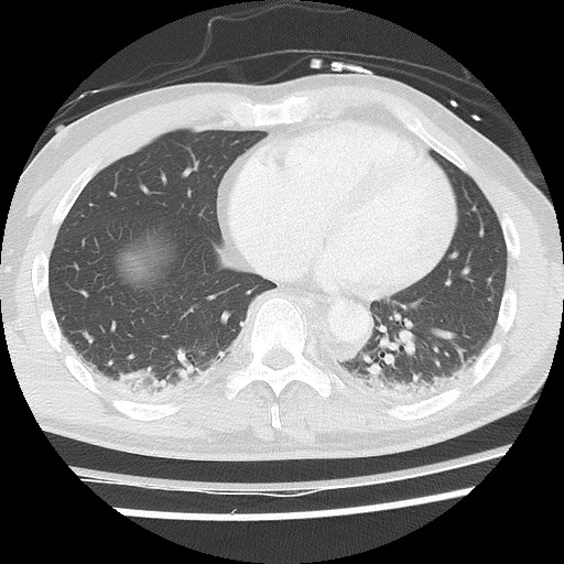 Benign post-traumatic pseudopneumoperitoneum (Radiopaedia 71199-81495 Axial lung window 49).jpg