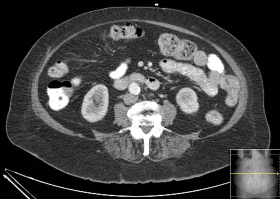 File:Bicameral celiacomesenteric aneurysm (Radiopaedia 55766-62327 A 35).jpg