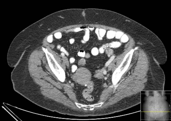 File:Bicameral celiacomesenteric aneurysm (Radiopaedia 55766-62327 A 58).jpg