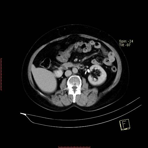 File:Bifid ureter (Radiopaedia 47604-52253 Axial C+ delayed 10).jpg