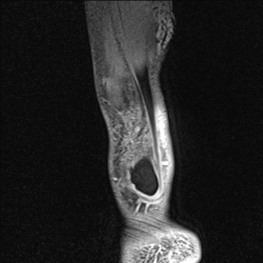 Bilateral Achilles tendon complete tear (Radiopaedia 81344-95051 Sagittal WE - Right 14).jpg