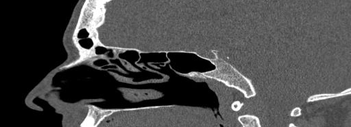 Bilateral Ectopic Infraorbital Nerves (Radiopaedia 49006-54084 Sagittal bone window 28).jpg