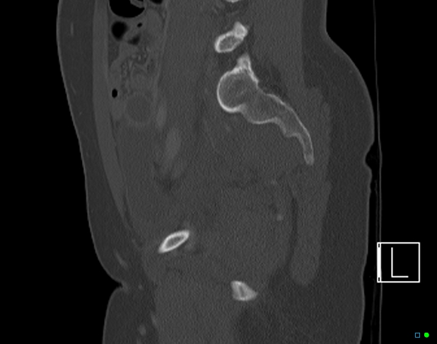 Bilateral acetabular fractures (Radiopaedia 79272-92308 Sagittal bone window 56).jpg