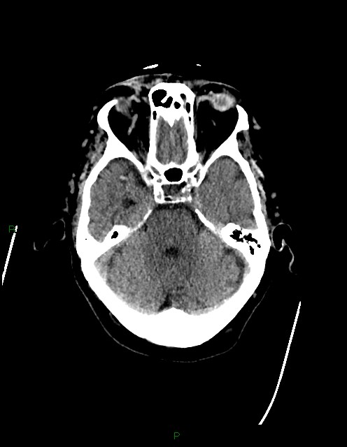 Bilateral acute middle cerebral artery territory infarcts (Radiopaedia 77319-89401 Axial non-contrast 26).jpg