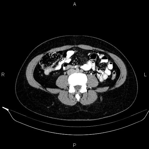 Bilateral adrenal myelolipoma (Radiopaedia 63058-71535 Axial C+ delayed 88).jpg