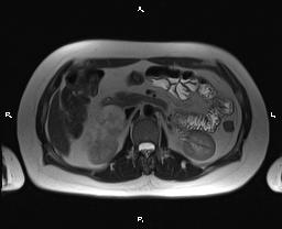 File:Bilateral adrenal myelolipoma (Radiopaedia 63058-71537 Axial T2 18).jpg