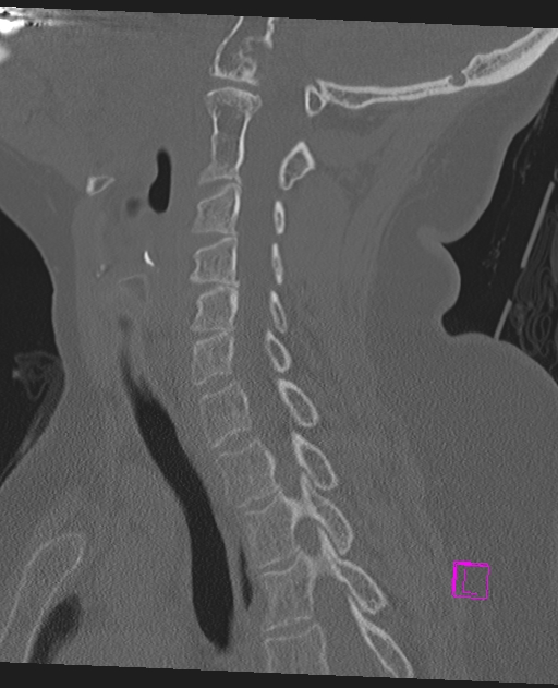 Bilateral atlanto-occipital assimilation (Radiopaedia 28350-28603 Sagittal bone window 46).jpg