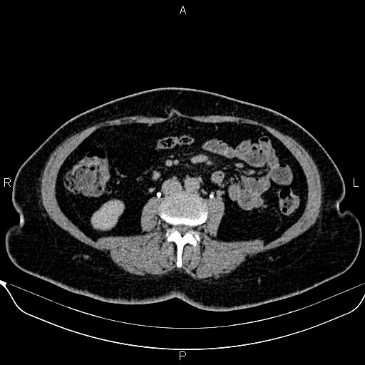 Bilateral benign adrenal adenomas (Radiopaedia 86912-103124 Axial C+ delayed 84).jpg
