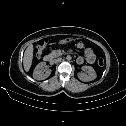 Bilateral benign adrenal adenomas (Radiopaedia 86912-103124 Axial non-contrast 49).jpg
