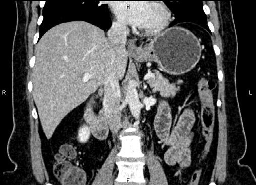 Bilateral benign adrenal adenomas (Radiopaedia 86912-103124 D 31).jpg
