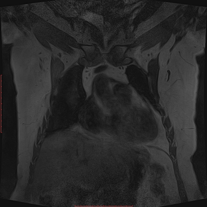 Bilateral breast implant rupture (Radiopaedia 24761-25027 G 6).jpg