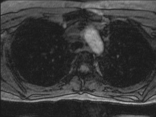 Bilateral carotid body tumors and right glomus jugulare tumor (Radiopaedia 20024-20060 Axial MRA 152).jpg