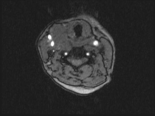 Bilateral carotid body tumors and right glomus jugulare tumor (Radiopaedia 20024-20060 Axial MRA 243).jpg