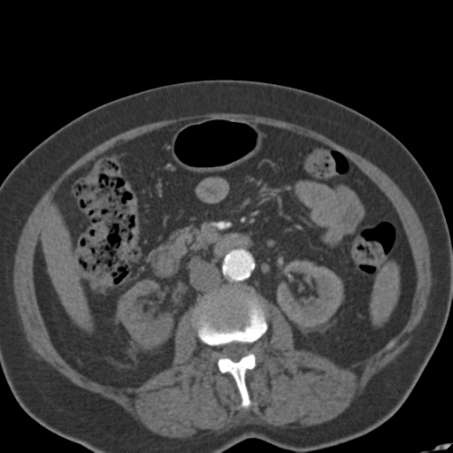 File:Bilateral delayed nephrogram from renal artery stenosis (Radiopaedia 47681-52362 A 27).png