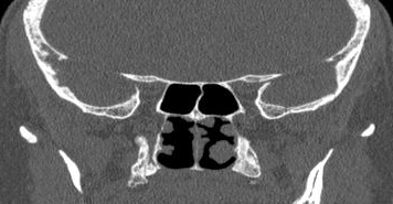 File:Bilateral ectopic infraorbital nerves (Radiopaedia 49006-54084 Coronal 4).png