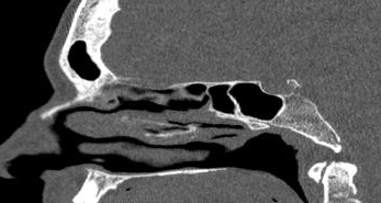 File:Bilateral ectopic infraorbital nerves (Radiopaedia 49006-54084 Sagittal 2).png