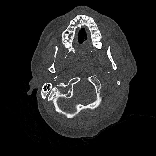 Bilateral occipital condyle fracture (type 2) (Radiopaedia 87675-104089 Axial bone thins 17).jpg