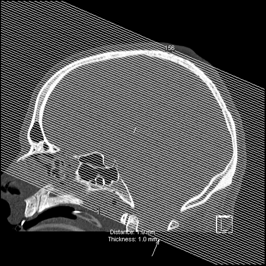 File:Bilateral occipital condyle fracture (type 2) (Radiopaedia 87675-104089 Axial bone window 129).jpg