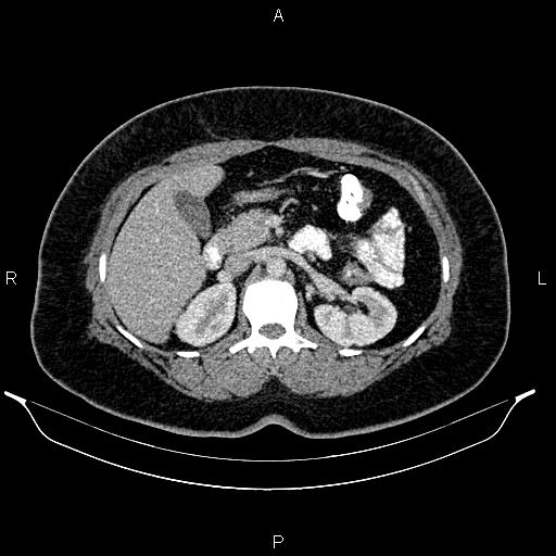 Bilateral ovarian dermoid cysts (Radiopaedia 85785-101603 A 41).jpg