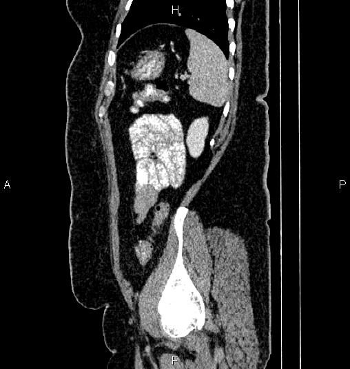 Bilateral ovarian dermoid cysts (Radiopaedia 85785-101603 D 78).jpg