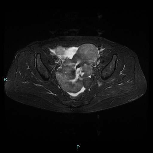 File:Bilateral ovarian fibroma (Radiopaedia 44568-48293 Axial STIR 14).jpg