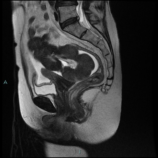 File:Bilateral ovarian fibroma (Radiopaedia 44568-48293 Sagittal T2 17).jpg