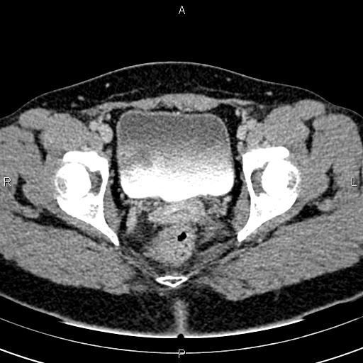 Bilateral ovarian teratoma (Radiopaedia 83131-97503 B 63).jpg