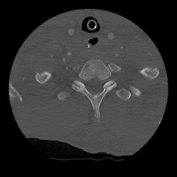 File:Bilateral perched facets with cord injury (Radiopaedia 45587-49713 Axial bone window 96).jpg