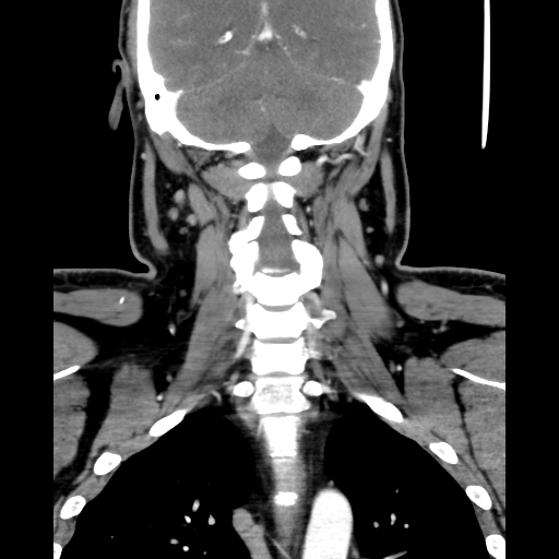 Bilateral peritonsillar abscess (Radiopaedia 85065-100610 Coronal 53).jpg
