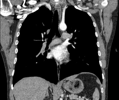 Bilateral pulmonary AVM (Radiopaedia 83134-97505 C 41).jpg