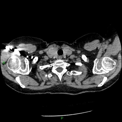 File:Bilateral pulmonary emboli (Radiopaedia 32700-33669 Axial C+ CTPA 5).jpg