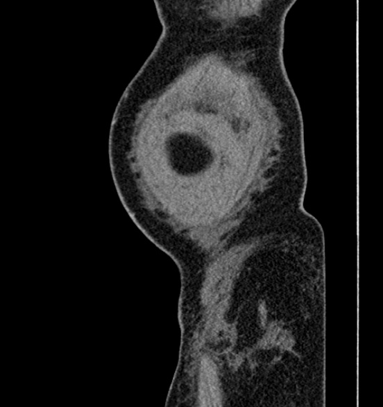 Bilateral rectus sheath hematomas (Radiopaedia 50778-56252 B 5).jpg