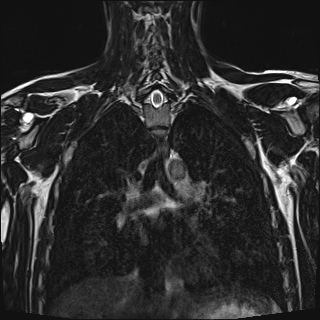 Bilateral spinoglenoid notch ganglion cysts (Radiopaedia 29577-30082 Coronal T2 75).jpg