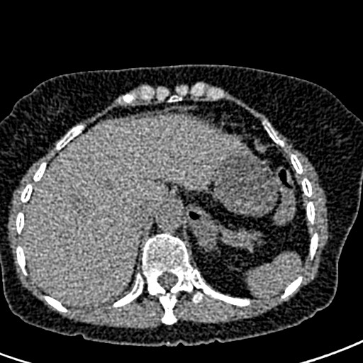 File:Bilateral staghorn calculi (Radiopaedia 59475-66842 Axial non-contrast 2).jpg