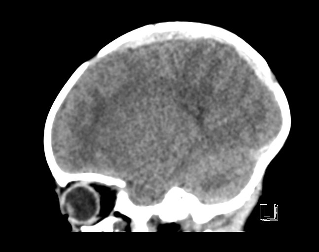 File:Bilateral subdural hemorrhage and parietal skull fracture (Radiopaedia 26058-26192 C 16).png