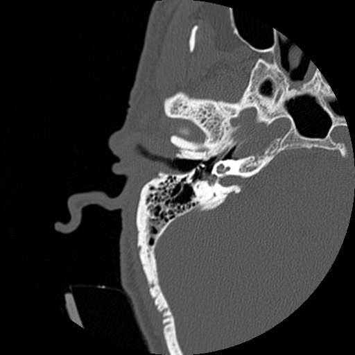 File:Bilateral temporal bone fractures (Radiopaedia 29482-29970 Axial non-contrast 23).jpg