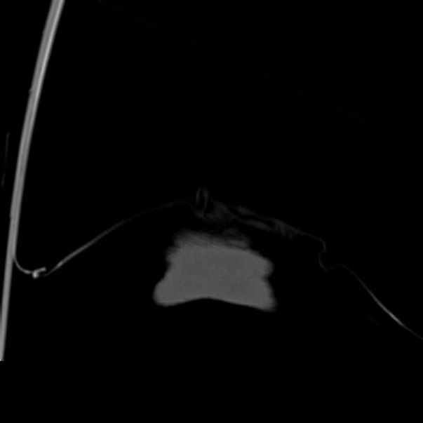 Biparietal osteodystrophy (Radiopaedia 46109-50463 Coronal bone window 111).jpg