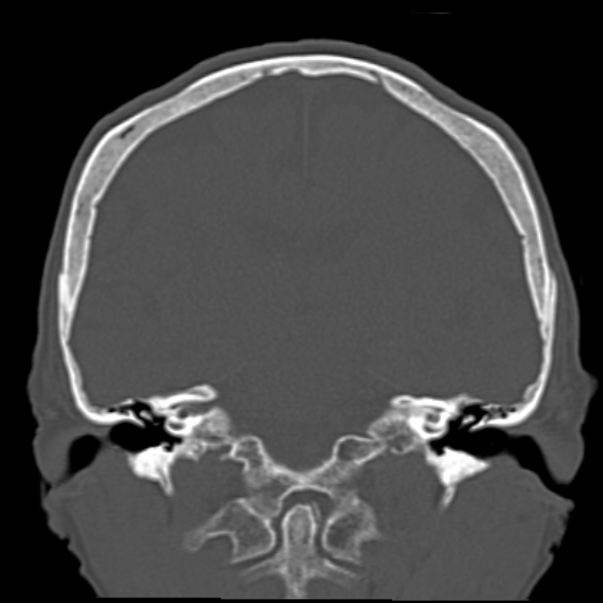 Biparietal osteodystrophy (Radiopaedia 46109-50463 Coronal bone window 60).jpg