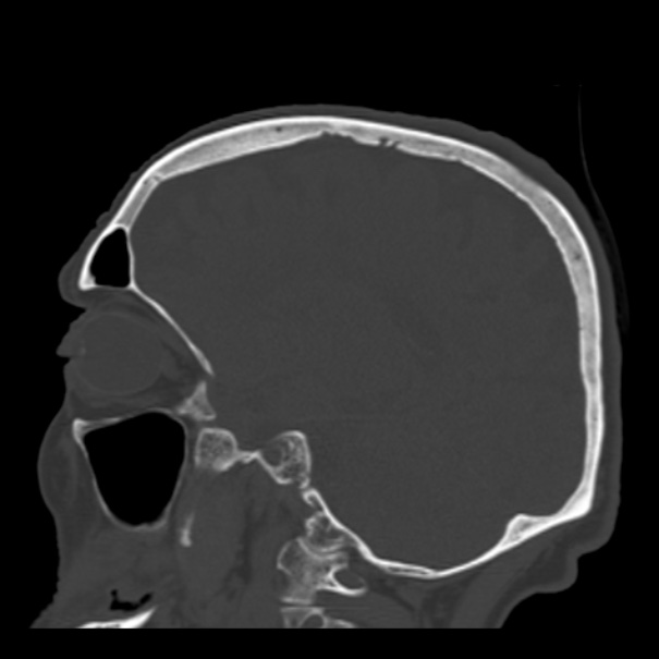 Biparietal osteodystrophy (Radiopaedia 46109-50463 Sagittal bone window 40).jpg