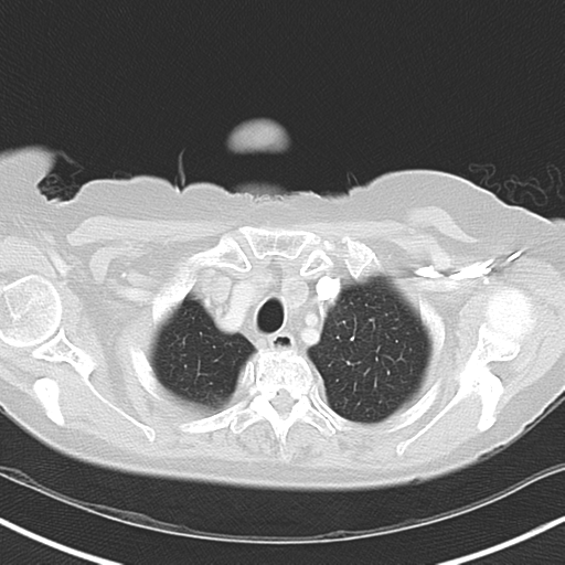 Bladder and bowel cancers (Radiopaedia 37688-39592 Axial lung window 8).png