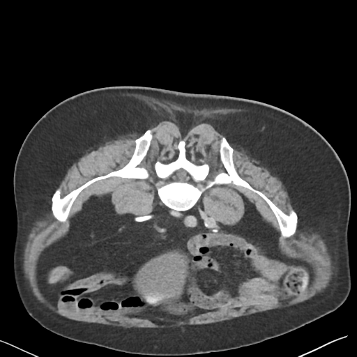 File:Bladder papillary urothelial carcinoma (Radiopaedia 48119-52951 Axial C+ delayed 37).png