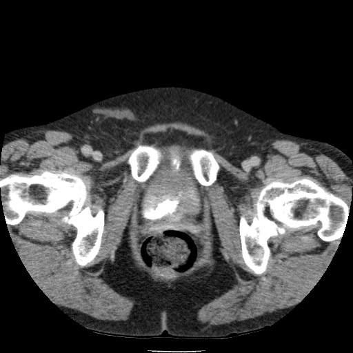 Bladder tumor detected on trauma CT (Radiopaedia 51809-57609 C 139).jpg