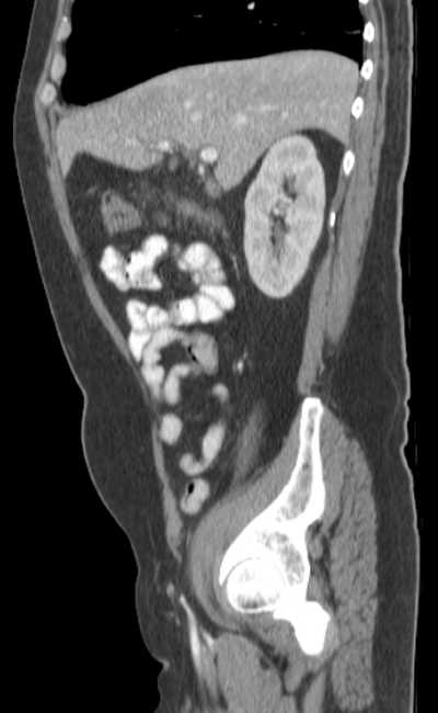 Bleeding duodenal ulcer and adenomyomatosis of gallbladder (Radiopaedia 61834-69861 C 29).jpg