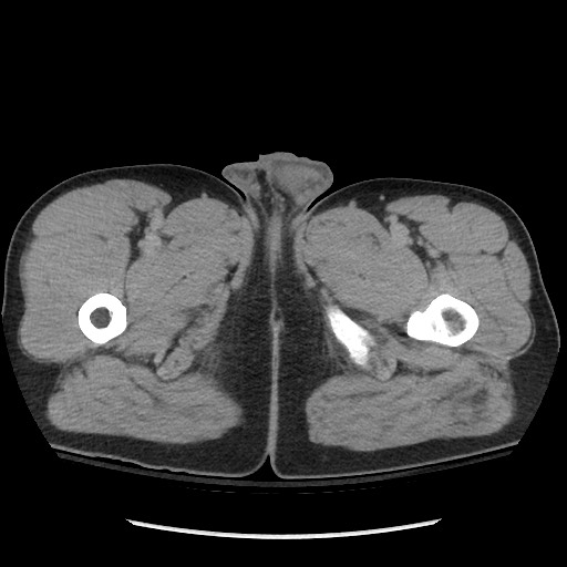 Blunt abdominal trauma with solid organ and musculoskelatal injury with active extravasation (Radiopaedia 68364-77895 Axial C+ delayed 156).jpg
