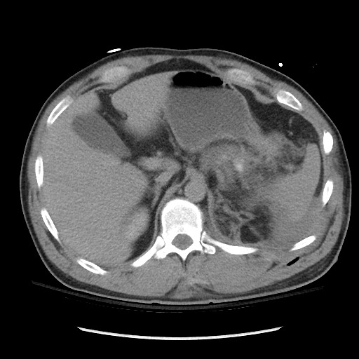 Blunt abdominal trauma with solid organ and musculoskelatal injury with active extravasation (Radiopaedia 68364-77895 Axial C+ delayed 35).jpg