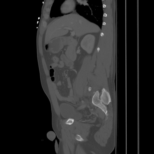 Blunt abdominal trauma with solid organ and musculoskelatal injury with active extravasation (Radiopaedia 68364-77895 Sagittal bone window 36).jpg